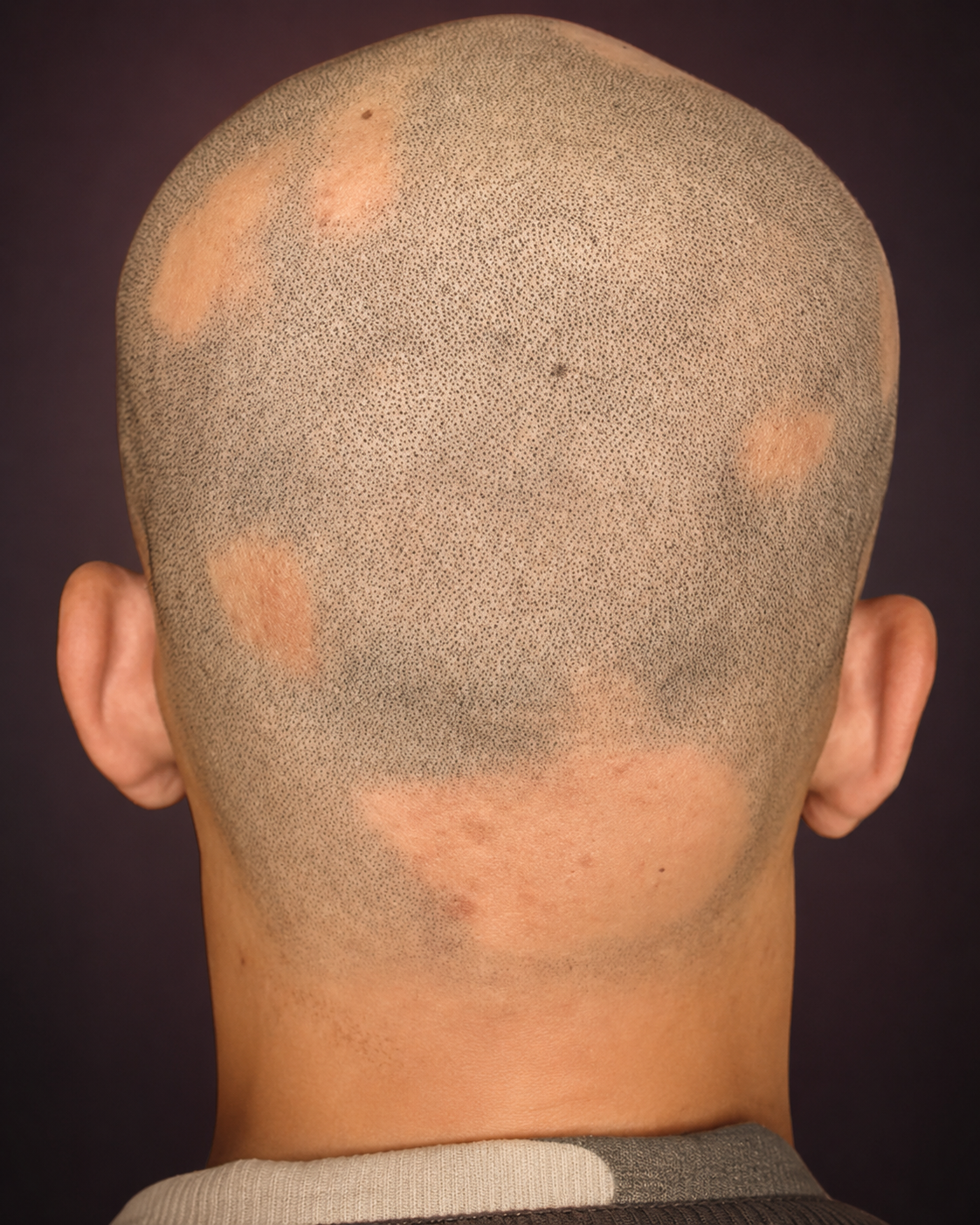Alopecia scalp micropigmentation before and after