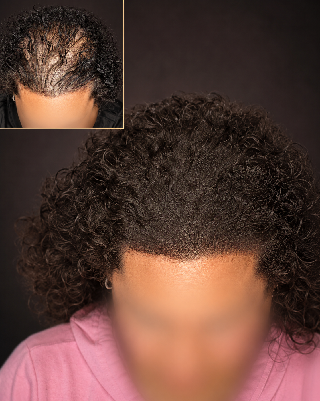 Women's hair density before and after